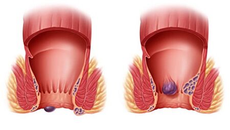 Proctonic ayuda con todo tipo de hemorroides